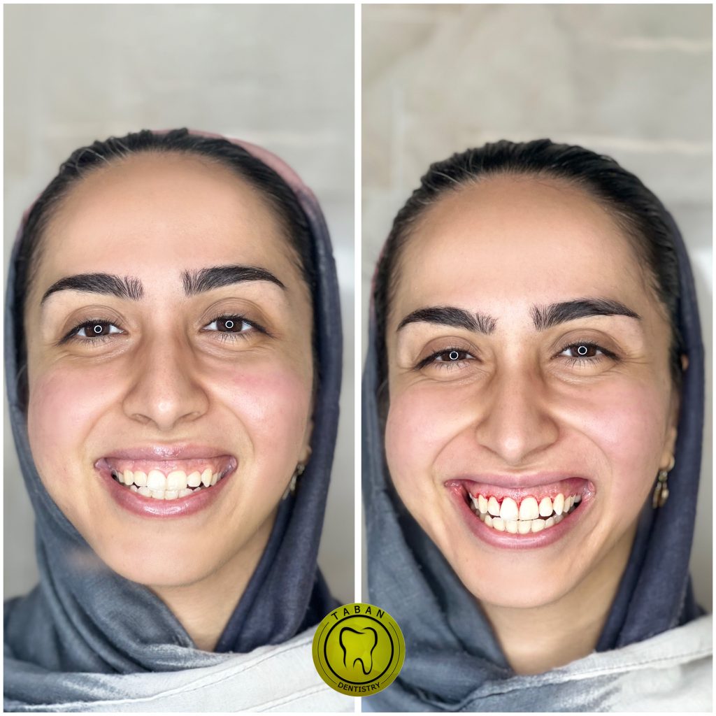 لیفت لثه با لیزر اربیوم 03