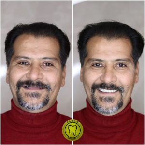 ایمپلنت 12