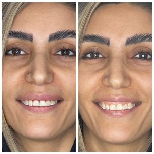 لیفت لثه با لیزر اربیوم 02