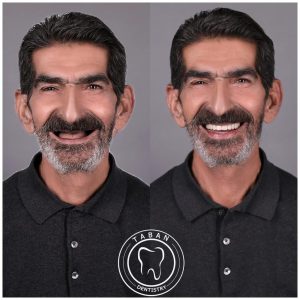 ایمپلنت 05