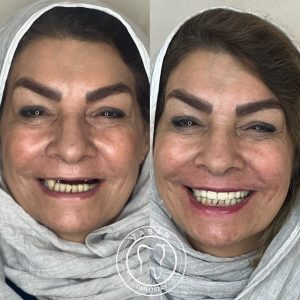 ایمپلنت 02