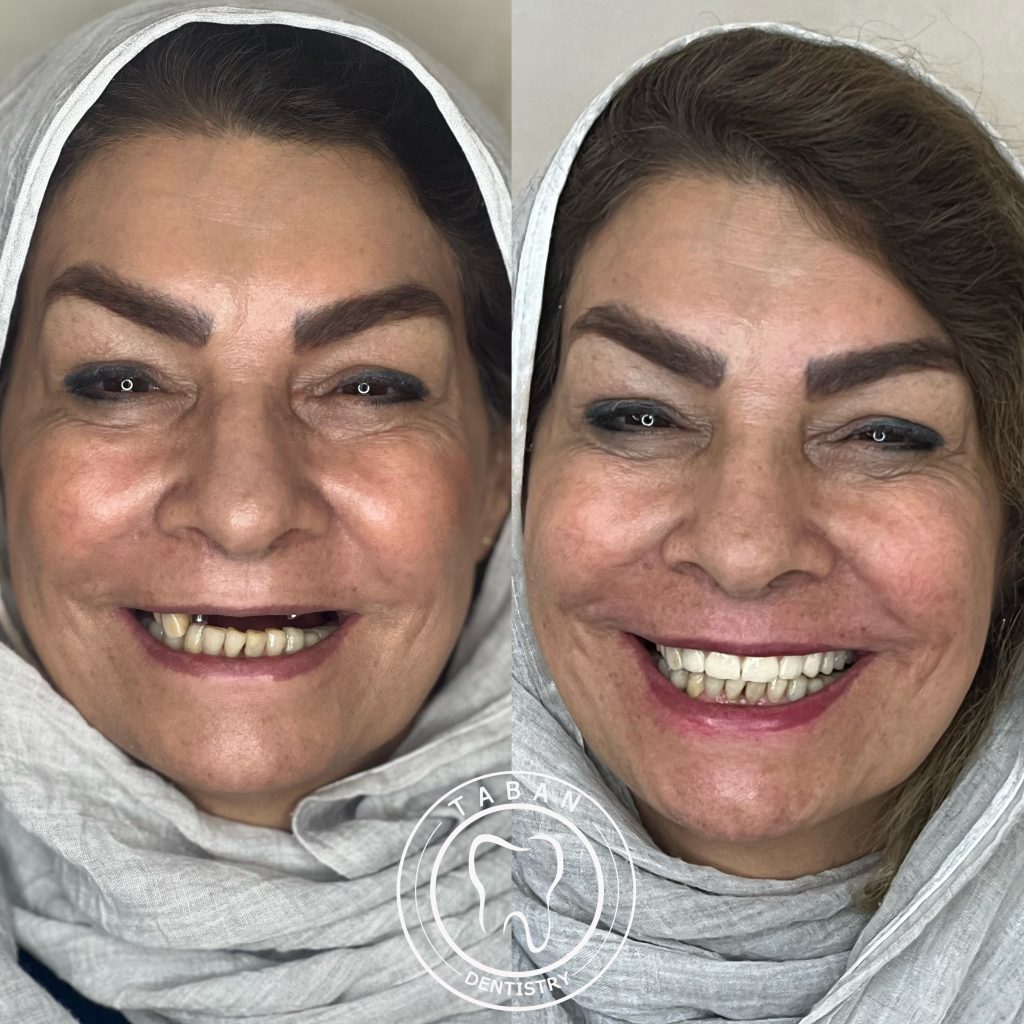 ایمپلنت 02