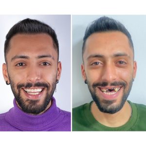 ایمپلنت 06