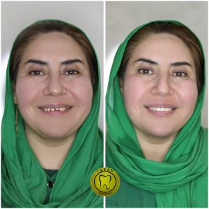 لمینت 01