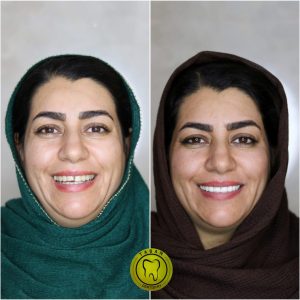 کامپوزیت 01