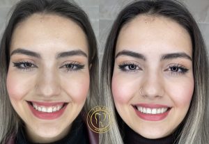 لیفت لثه با لیزر اربیوم 01