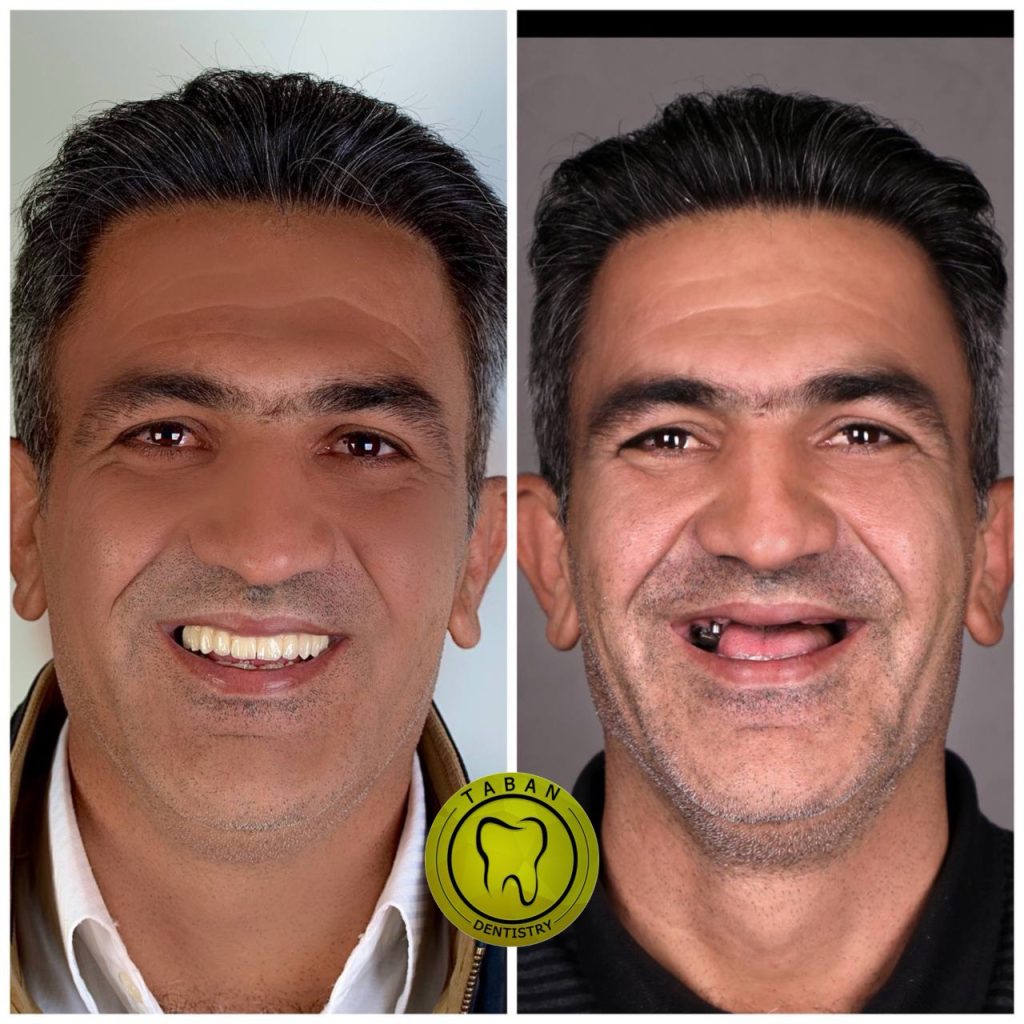 ایمپلنت 16