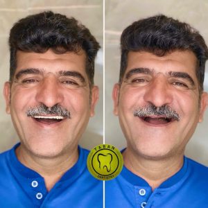 ایمپلنت 17